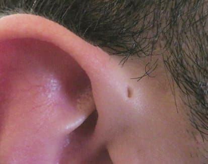Sangat yang selaput maka telinga adalah bunyi akan terjadi tipis gendang jika terkena PATOLOGI
