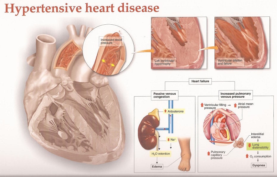 Hipertensi heart